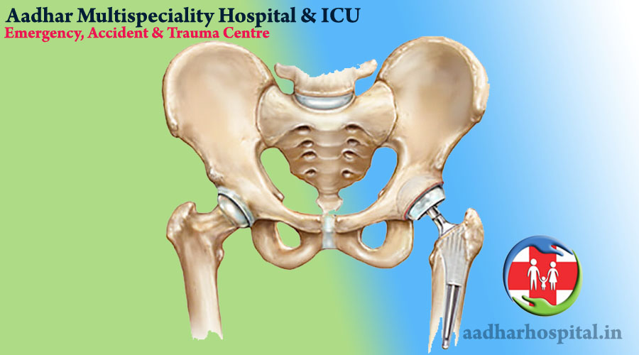 joint replacement